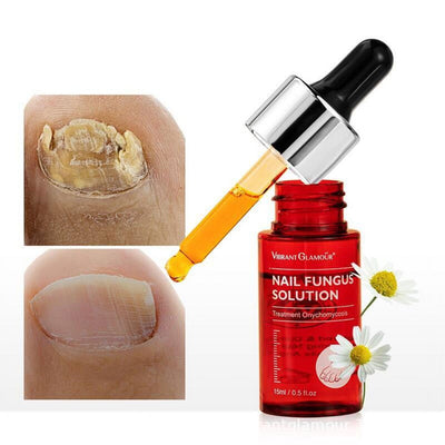 Foot Cure Extra Strong Nail & Toe Fungus Treatment -, Nail Repair, Fungi Fingernail & Toenail Solution, Fix & Renew Damage Nail
